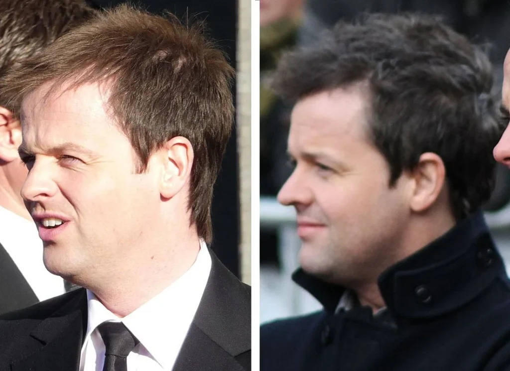 declan donnelly hair before and after