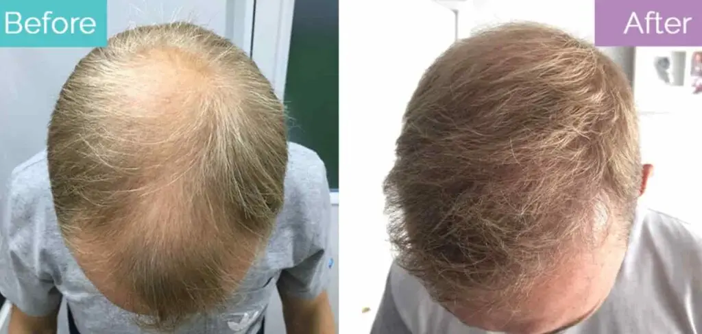 grey transplant hair