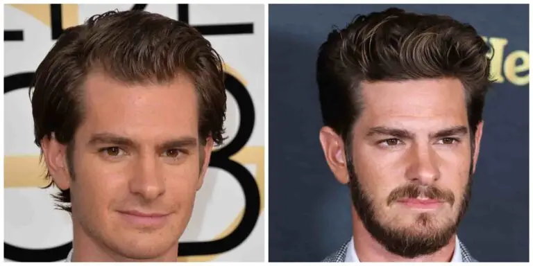 Andrew garfield hair transplant before and after