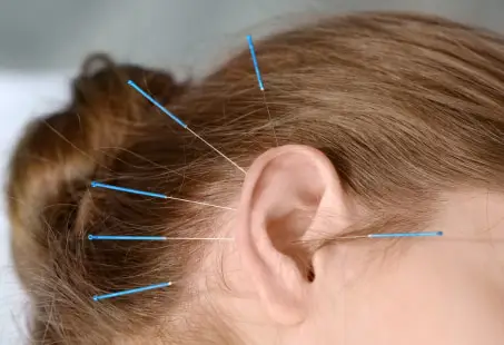 acupuncture for hair loss