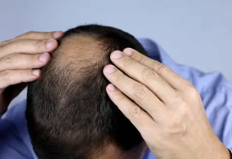 hair loss in man