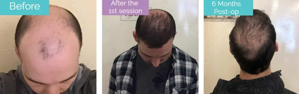 6000 65000 grafts hair transplant