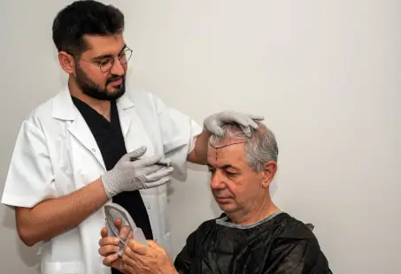 8000 grafts hair transplant