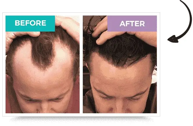 hair transplant before and after