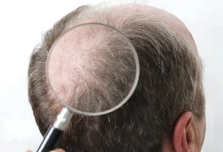 A magnifying glass examines a person's thinning hair on the scalp against a white background.