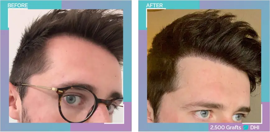 Before and After comparison of a Hair Transplant in Turkey