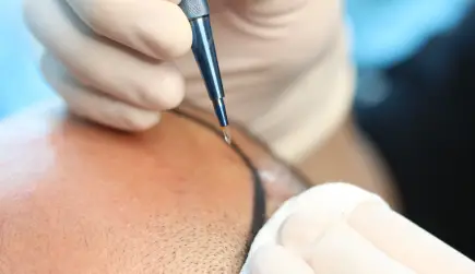 ICE Graft Hair Transplant Turkey