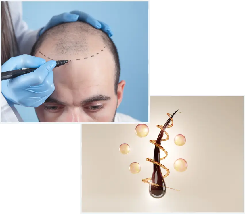 Preparing for a Hair Transplant in Turkey