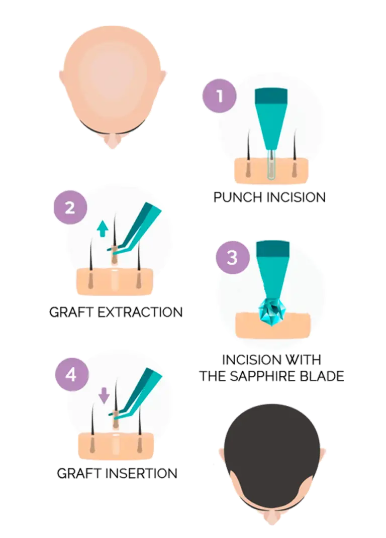 sapphire hair transplant longevita 2