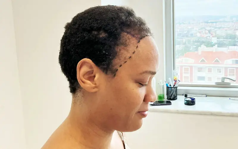 A female hair transplant patient smiles while showing her hairline right before her surgery.