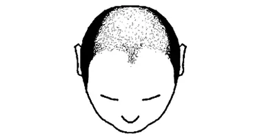 Male Pattern Baldness Norwood Scale Stage 5a