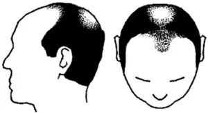 Male Pattern Baldness Norwood Scale Stage 6