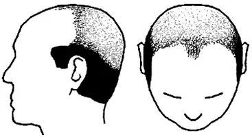 Male Pattern Baldness Norwood Scale Stage 7