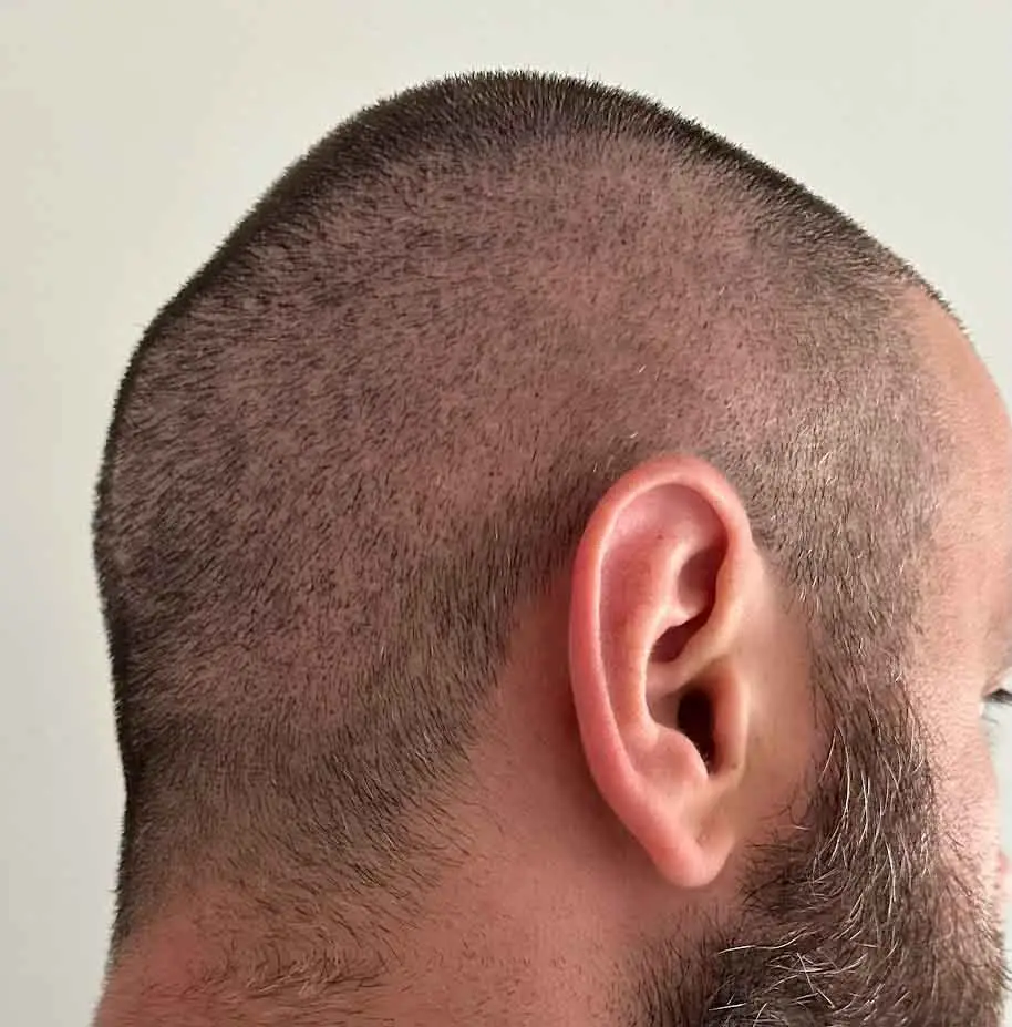 Close-up of a hair transplant patient showing healing progress on the transplanted head and improving donor area.