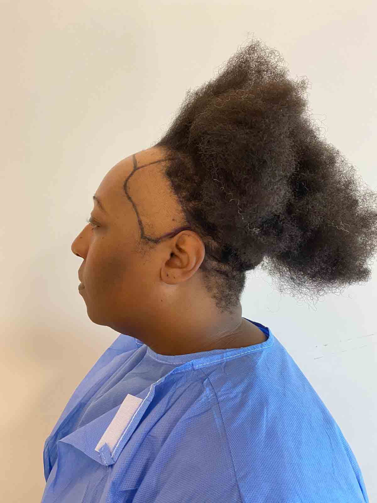 Woman in scrubs preparing for a hair transplant surgery, focused and ready for the procedure.