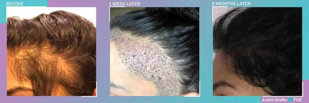 female hair transplant recovery