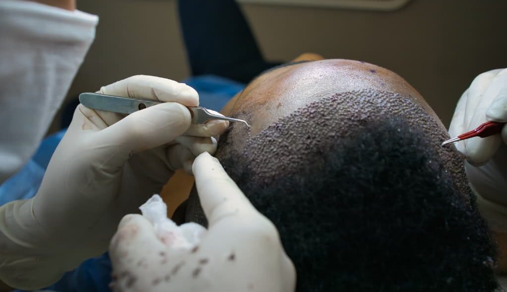 Afro hair transplant