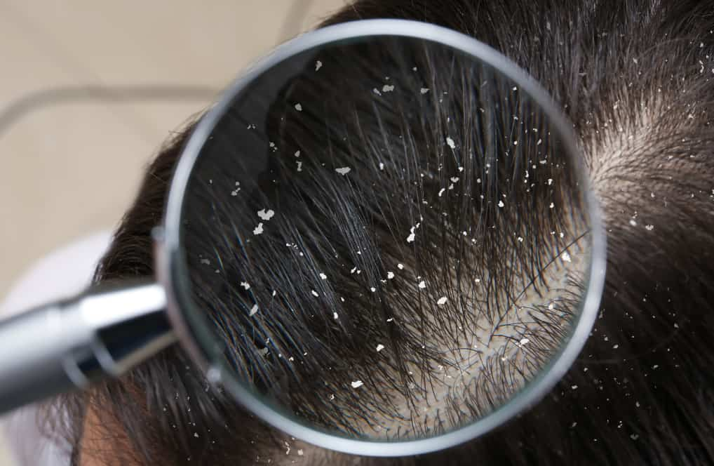 Dandruff