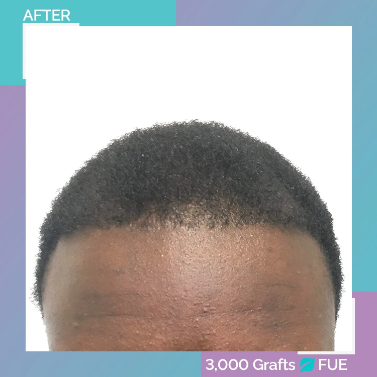 afro B A 4 after