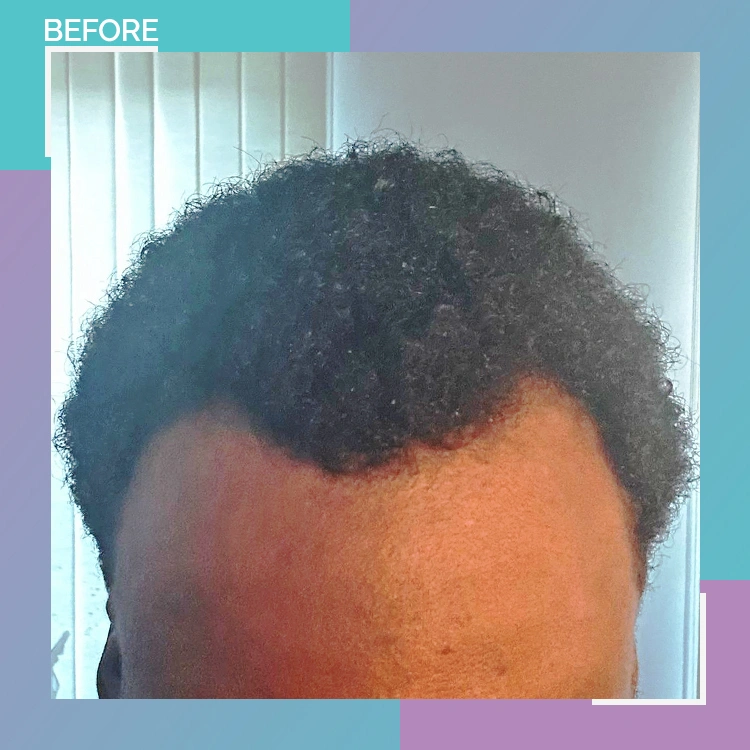 afro B A 8 before