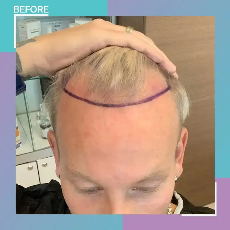 hair transplant turkey before after fue 13