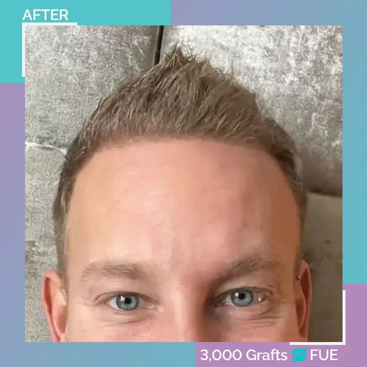 hair transplant turkey before after fue 14