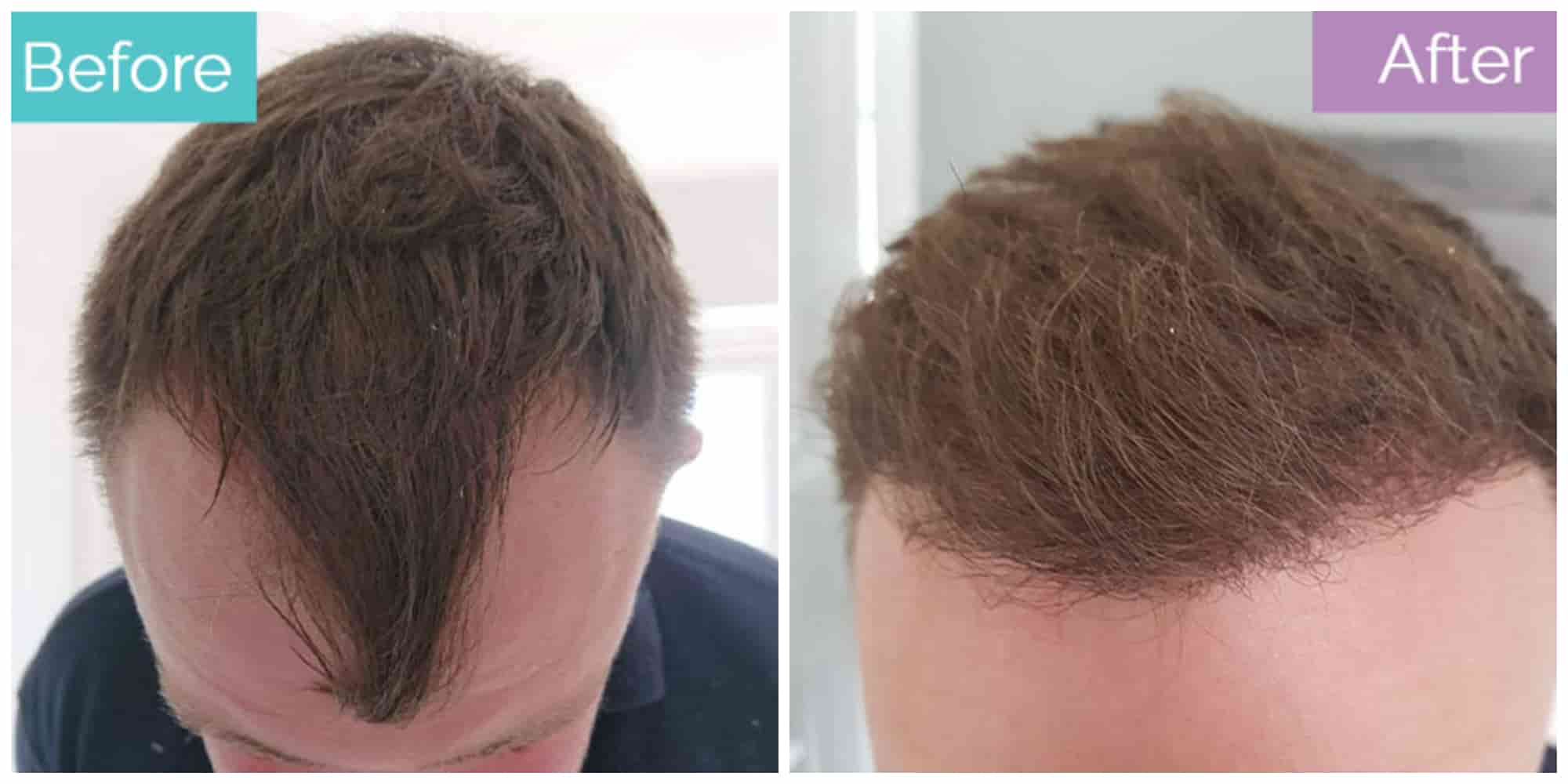 slight dandruff hair transplant before and after