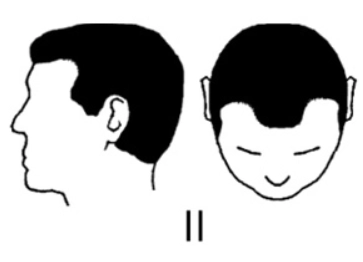 norwood scale 2